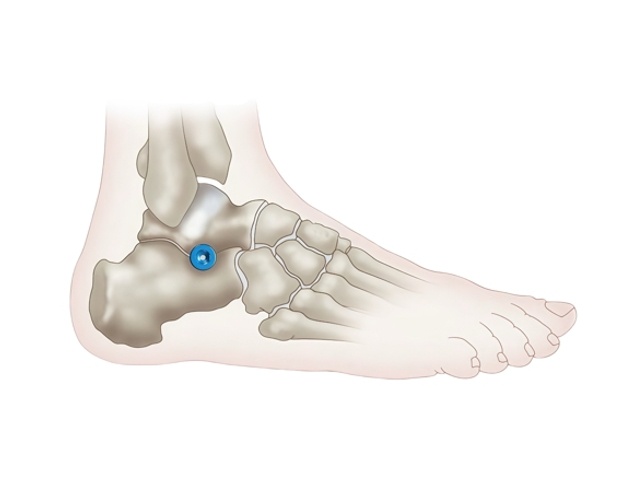 Subtalar Arthroereisis for the Treatment of Flatfoot